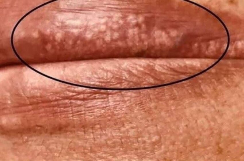  If you are getting these pimples on your lips or int;im:ate area, it is because…