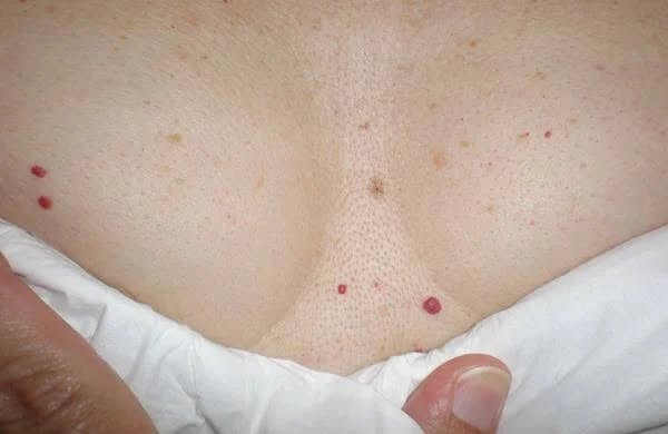  What are the red spots that appear on the skin?