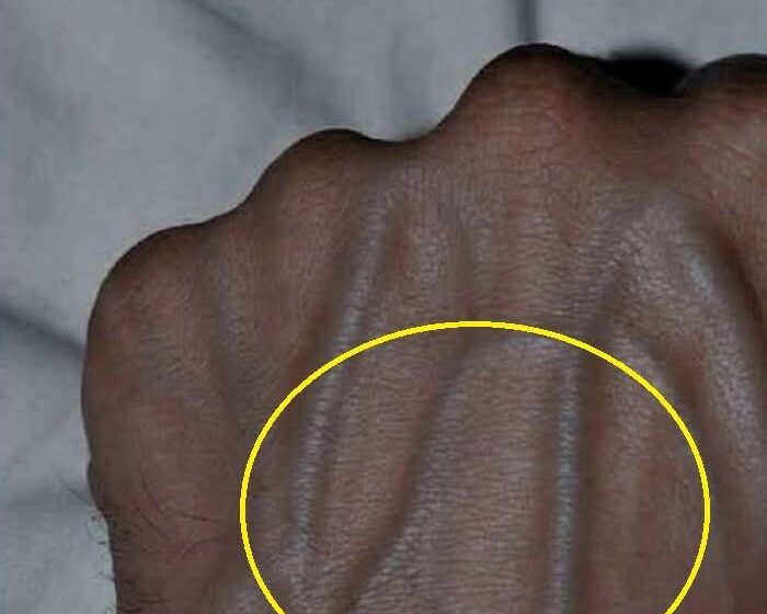  If your veins are visible in your hand, it is a signal of ca…