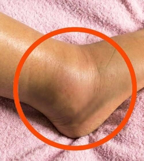  What Swollen Legs or Ankles Could Mean