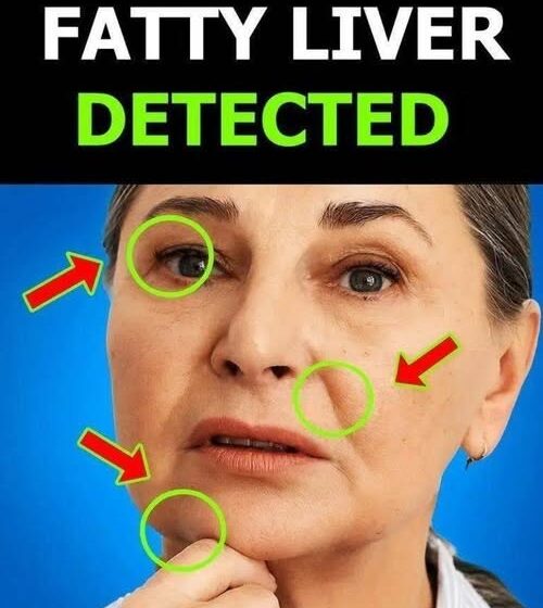  Everyone with fatty liver has this in common! A hidden sign you should know about.