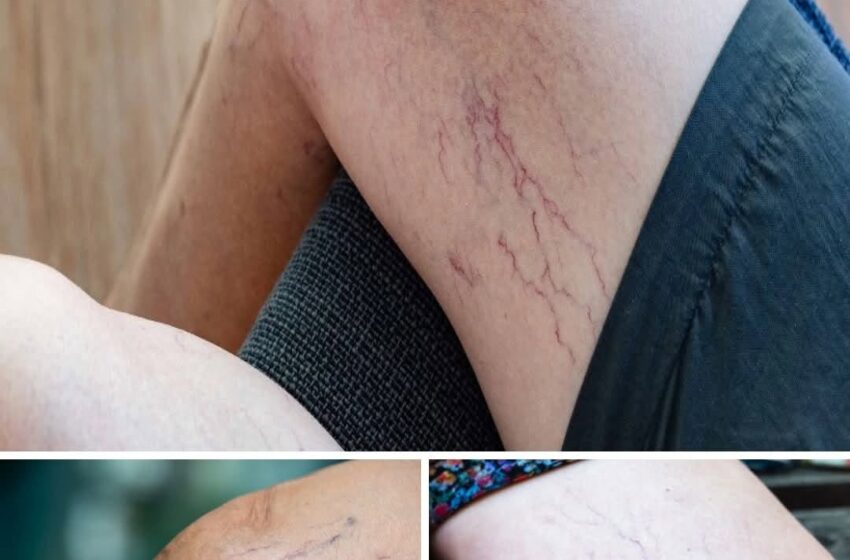  If you have purple veins on your legs, it means you are…