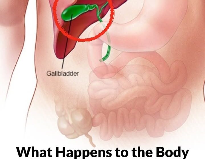  What Happens to the Body After Gallbladder Removal? 3 Diseases That May Follow – Avoid Surgery If Possible